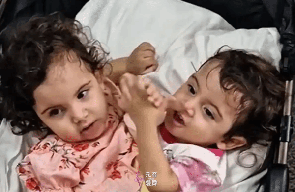 巴西一对连体双胞胎接受分离手术 术后却相继去世