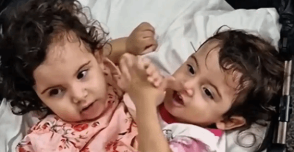 巴西一对连体双胞胎接受分离手术 术后却相继去世